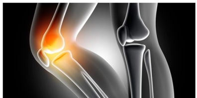 Lesiones condrales o lesiones del cartilago en la rodilla